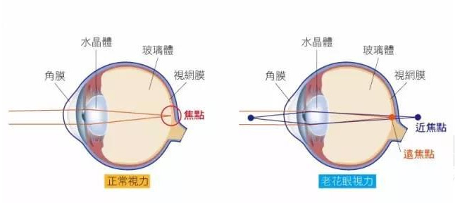 白內(nèi)障和老花眼區(qū)別，老花眼發(fā)病率正呈現(xiàn)年輕化趨勢(shì)